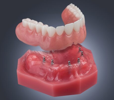 Implantes Dentales en Wayne, NJ | Dr. Bruce Fine | Mini Implantes