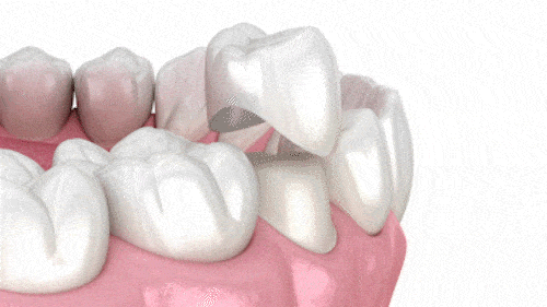 Coronas Dentales en Wayne, NJ | Dr. Bruce Fine | Fine Dental Care