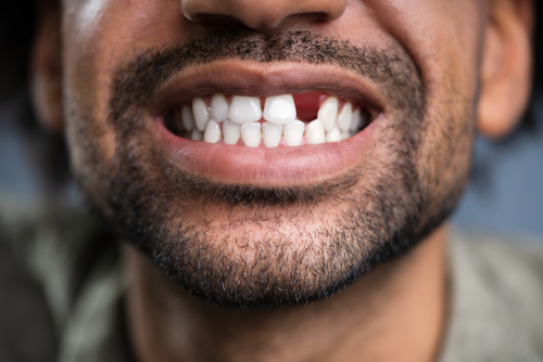 Missing Teeth in Wayne, NJ | Mini Dental Implants | Dr. Bruce Fine