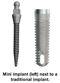 Mini Dental Implants vs. Traditional Implants | Wayne, NJ | Dr. Fine