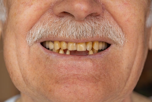 Missing Teeth in Wayne, NJ | Book a Free Implant Consultation!