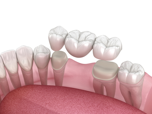 Dientes perdidos en Wayne, Nueva Jersey | Sustituye tu diente por un puente dental