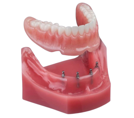 Snap-In Dentures in Wayne, NJ | Mini Dental Implants | Dr. Fine