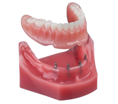 Snap-In Dentures in Wayne, NJ | Mini Dental Implants | Dr. Fine