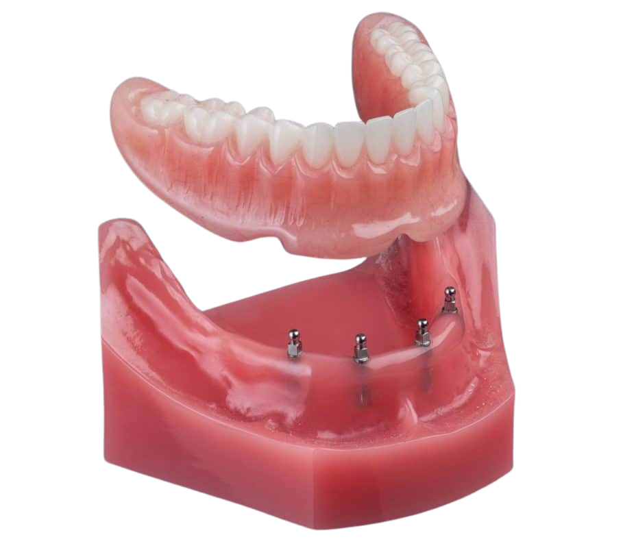 Snap-In Dentures in Wayne, NJ | Mini Dental Implants | Dr. Fine