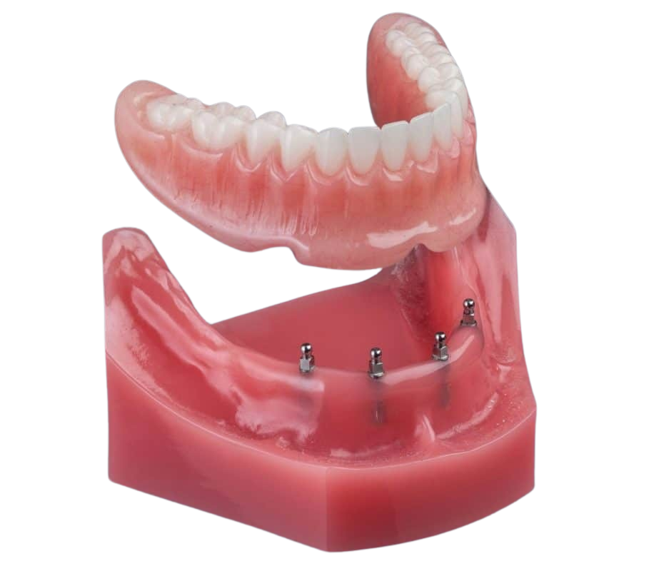 Snap-In Dentures in Wayne, NJ | Mini Dental Implants | Dr. Fine