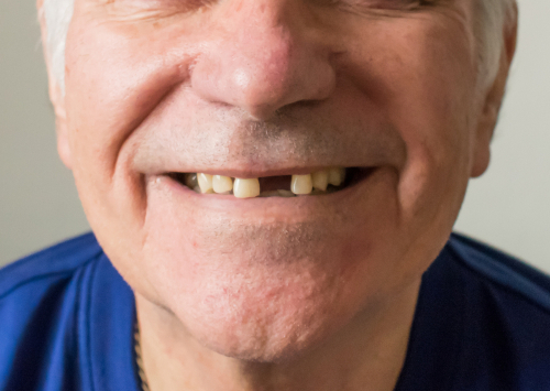 Perdida de Dientes en Wayne, NJ | Dientes Nuevos | Mini Implantes | Dr. Fine