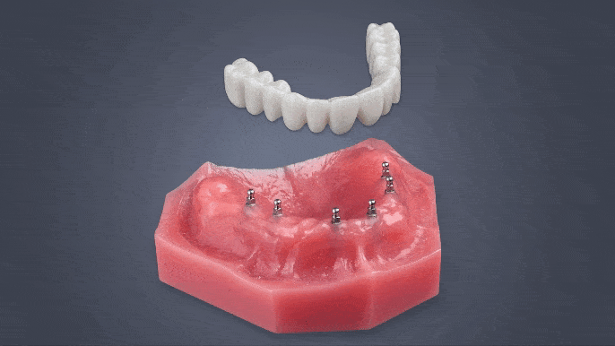 Implantes Dentales All-on-X en Wayne, NJ | Mini Implantes | Fix-on-Six