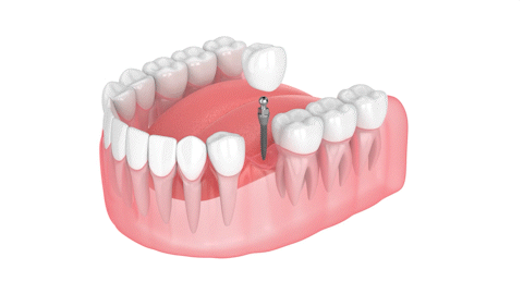 Implantes Dentales Asequibles en Wayne, NJ | Mini Implantes Dentales