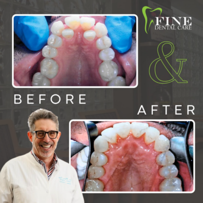 Invisalign Aligners in Wayne, NJ | Transform Your Smile With Confidence