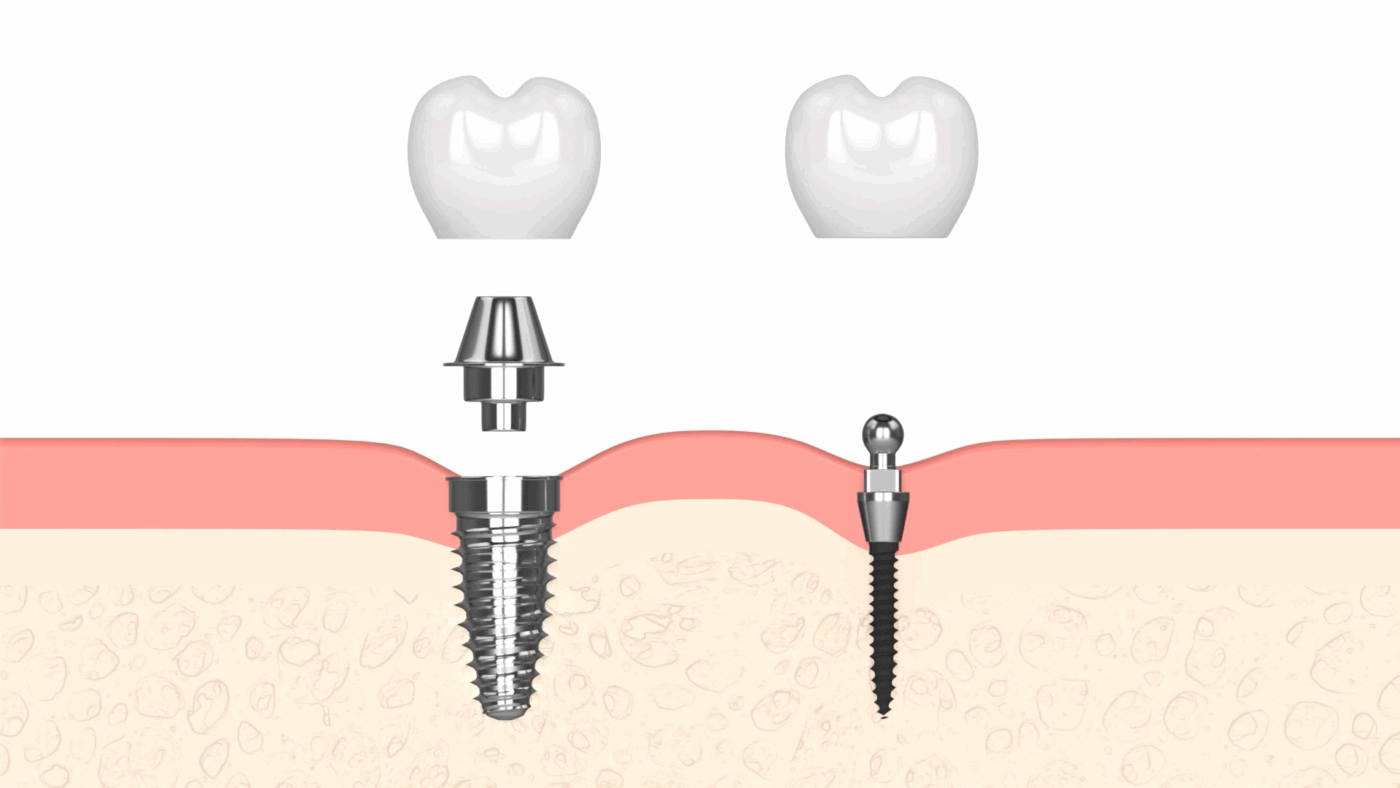 Wayne Implant Dentist in NJ Book a Free Consultation Today!