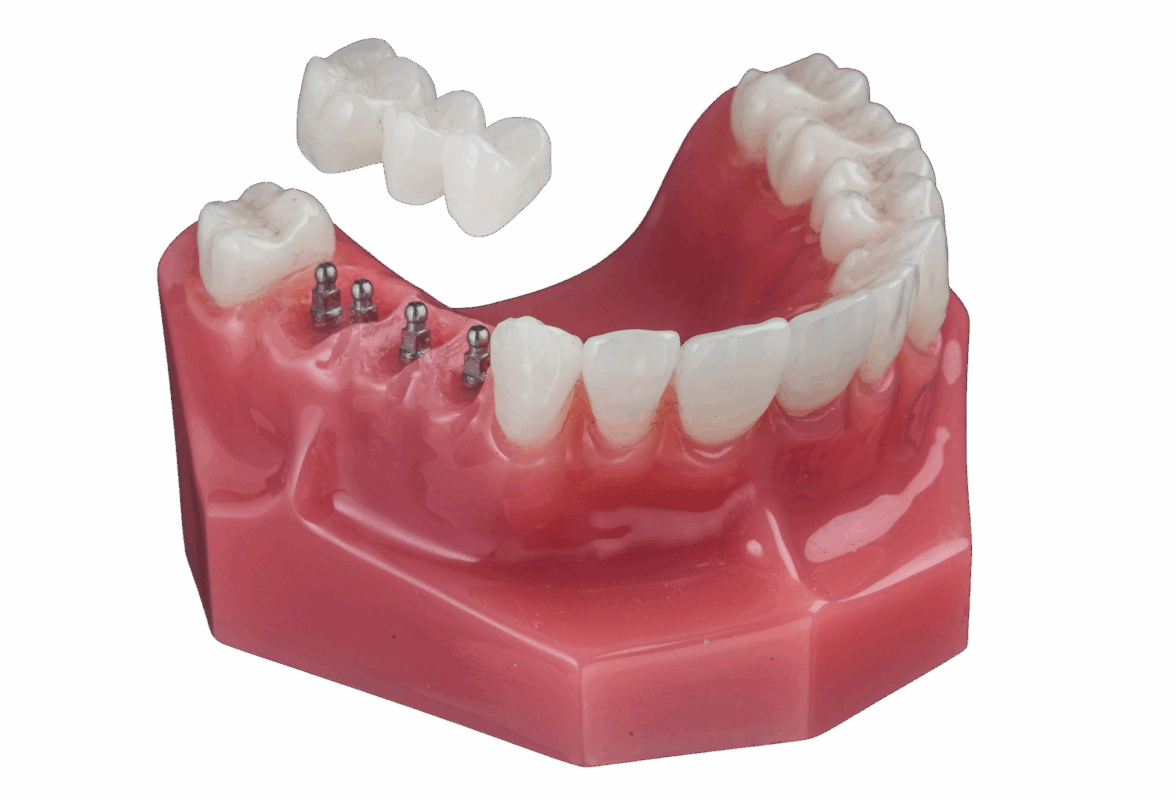 Implantes dentales en Orange County, NY Reserve una consulta gratuita