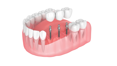 Implantes dentales en Orange County, NY | Reserve una consulta gratuita
