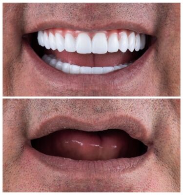 ¡Mini Implantes en el Condado de Sullivan, NY | Reserve una consulta gratuita!