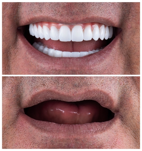 Mini Implants in Sullivan County, NY | Book a Free Consultation!