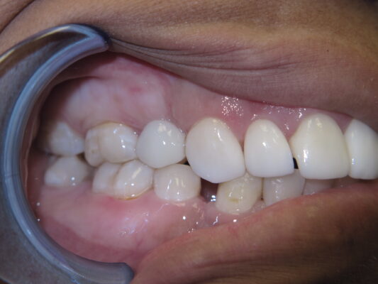 Mini Dental Implants in Passaic County, NJ | Free Consultations!
