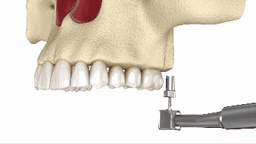 Sinus Lift in Wayne, NJ | The Less Invasive Sinus Bump