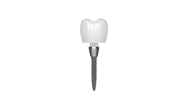 Mini Dental Implants in Union County, NJ | Free Consultations