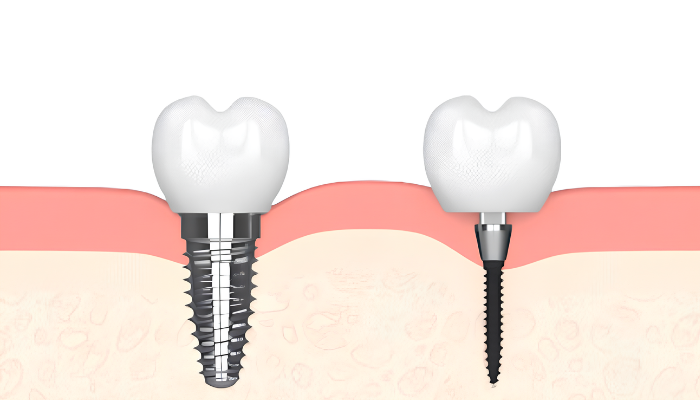Mini Implante vs Implante Regular | ¡Consultas Gratuitas en Wayne, NJ!